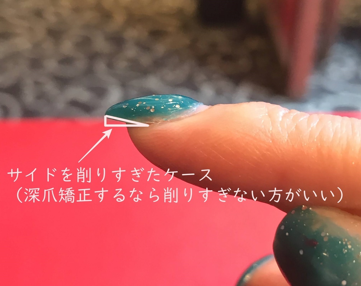 深爪を自分で直すこと出来る 爪をキレイに矯正する方法